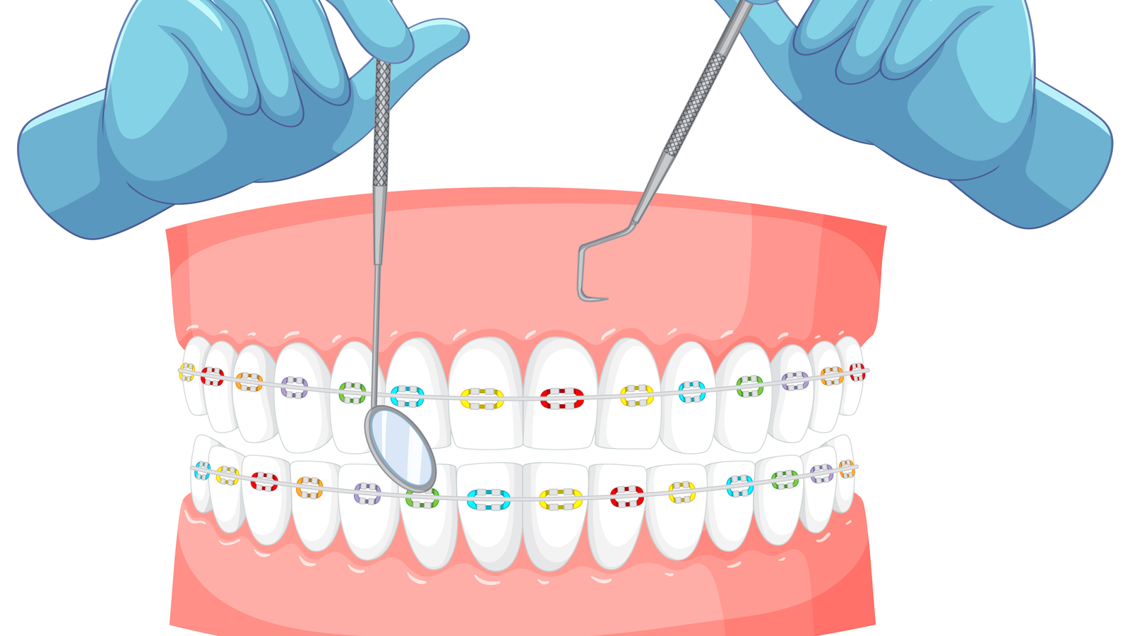 Braces in Plain Language: Brackets, Wires and How Teeth Actually Move